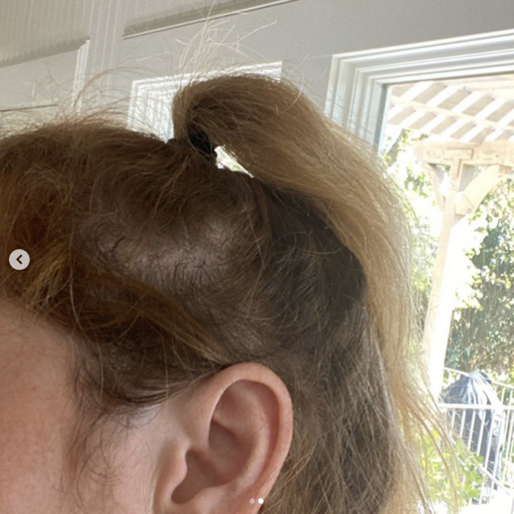 thin ponytail with scalp peeking through depicting the severity of hair loss